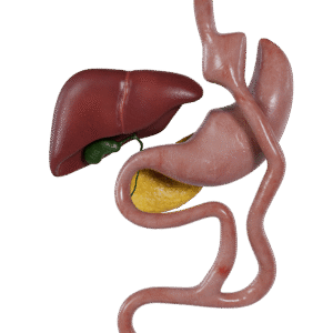 Gastrik Bypass