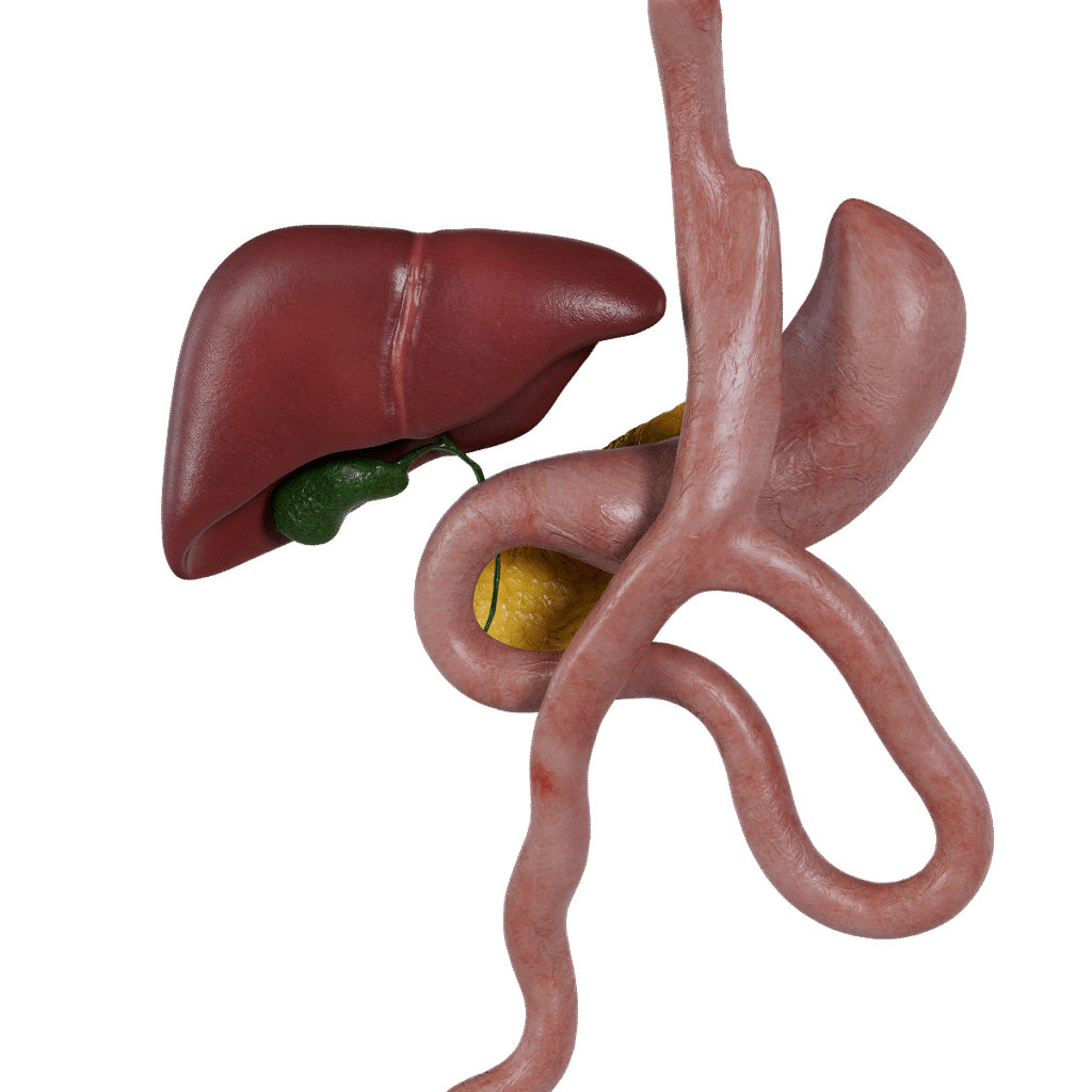 Mini Gastrik Bypass