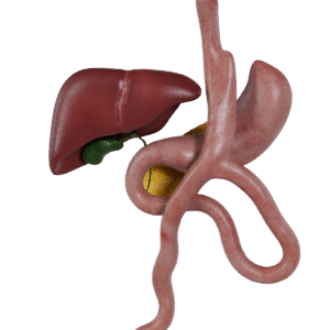 Mini Gastrik Bypass